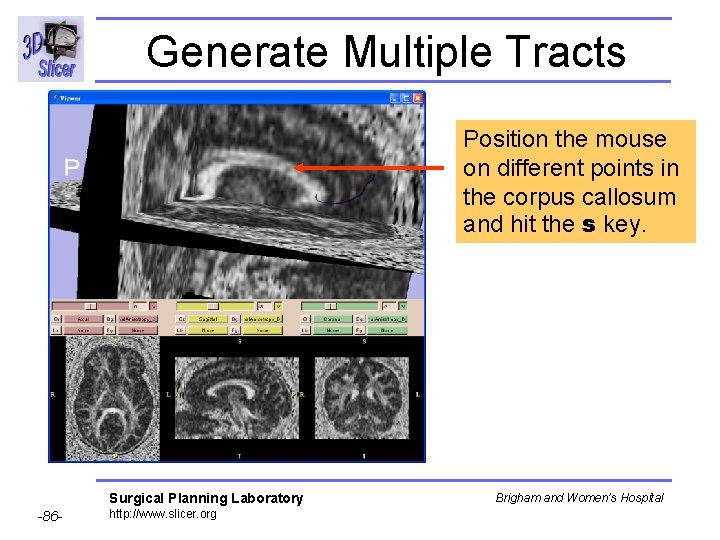 Generate Multiple Tracts Position the mouse on different points in the corpus callosum and