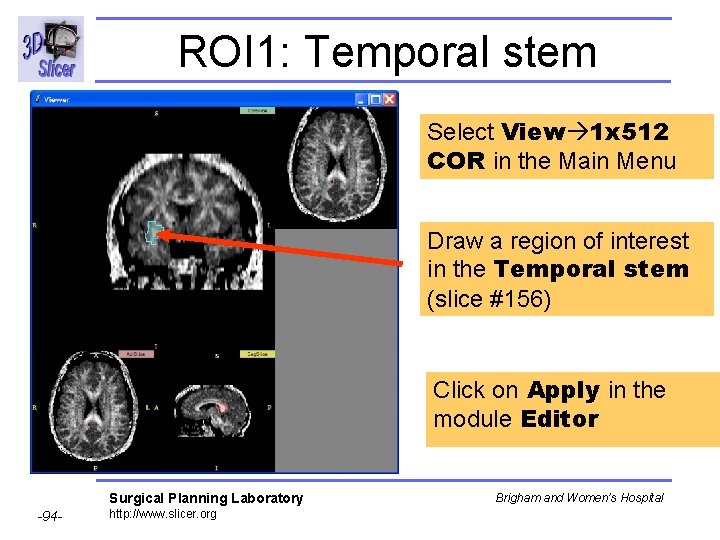 ROI 1: Temporal stem Select View 1 x 512 COR in the Main Menu