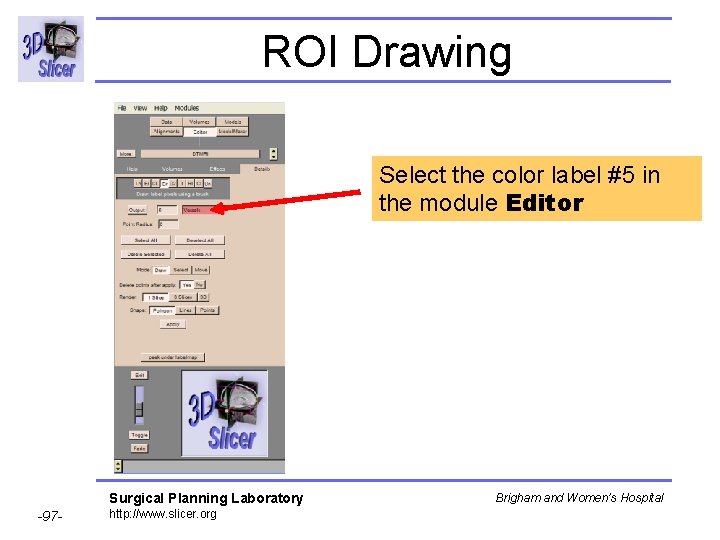 ROI Drawing Select the color label #5 in the module Editor Surgical Planning Laboratory