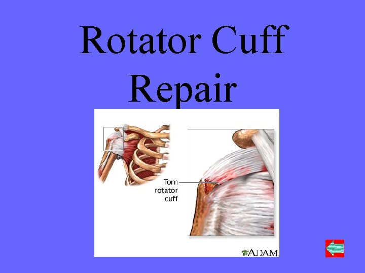 Rotator Cuff Repair 100 Points 