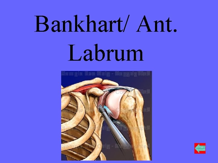 Bankhart/ Ant. Labrum 80 Points 