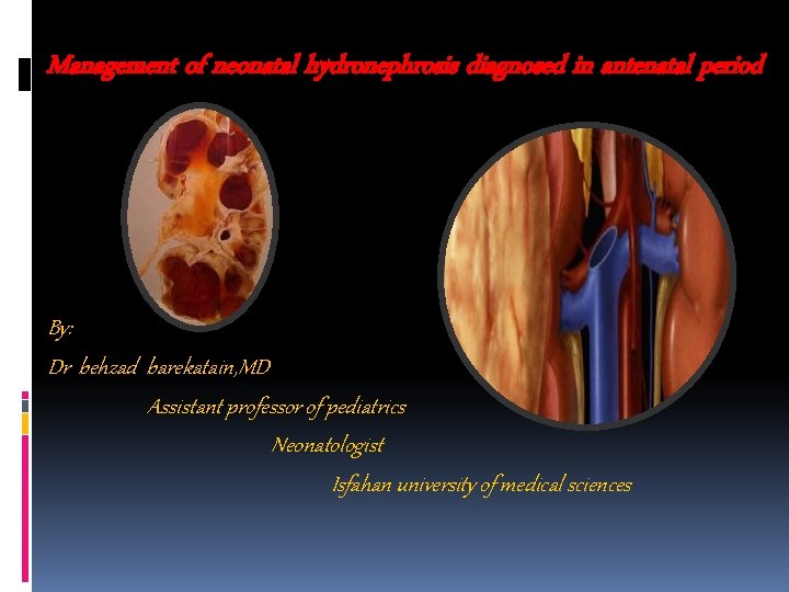 Management of neonatal hydronephrosis diagnosed in antenatal period By: Dr behzad barekatain, MD Assistant