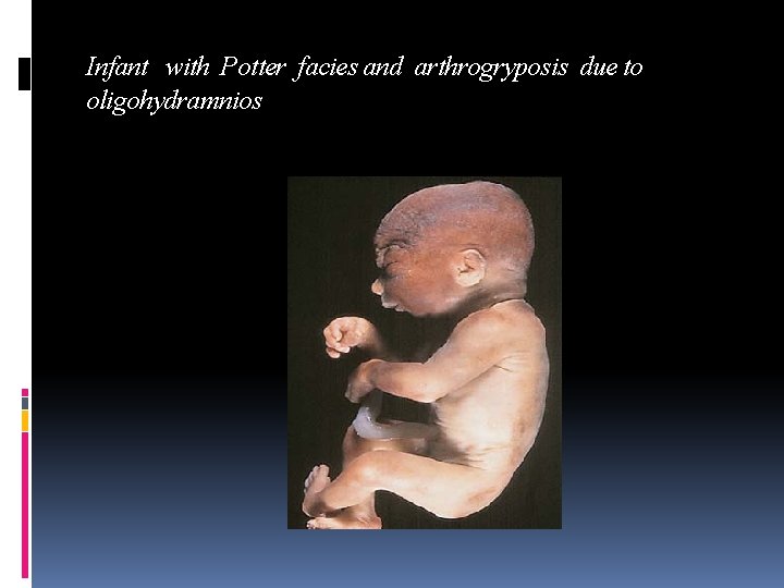 Infant with Potter facies and arthrogryposis due to oligohydramnios 