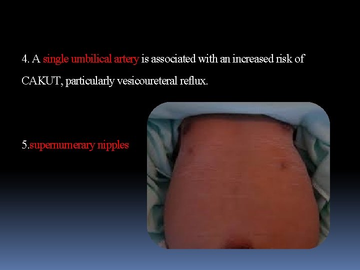 4. A single umbilical artery is associated with an increased risk of CAKUT, particularly