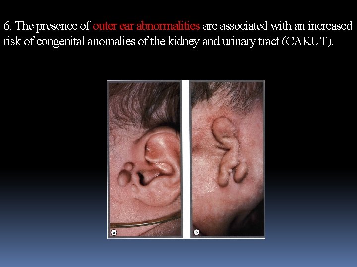 6. The presence of outer ear abnormalities are associated with an increased risk of