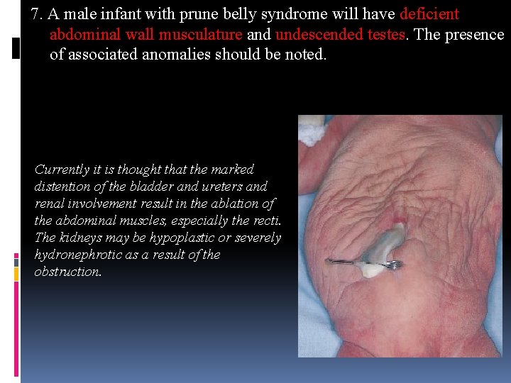 7. A male infant with prune belly syndrome will have deficient abdominal wall musculature