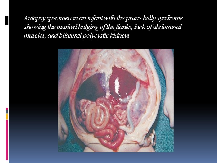 Autopsy specimen in an infant with the prune belly syndrome showing the marked bulging