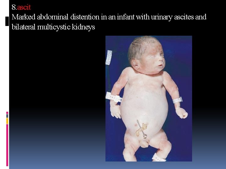 8. ascit Marked abdominal distention in an infant with urinary ascites and bilateral multicystic