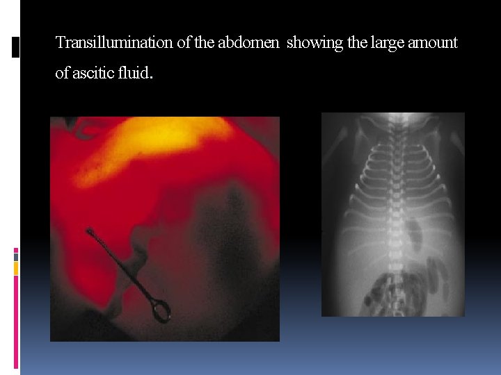 Transillumination of the abdomen showing the large amount of ascitic fluid. 