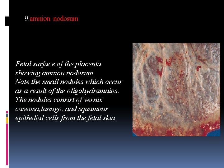 9. amnion nodosum Fetal surface of the placenta showing amnion nodosum. Note the small