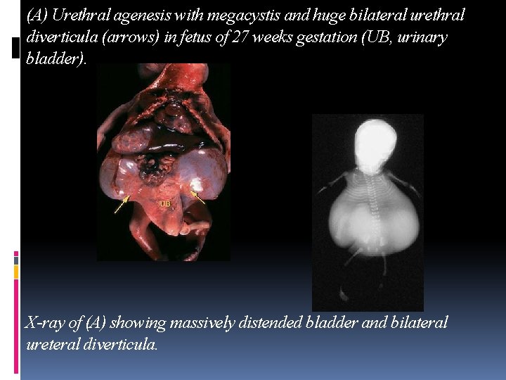 (A) Urethral agenesis with megacystis and huge bilateral urethral diverticula (arrows) in fetus of