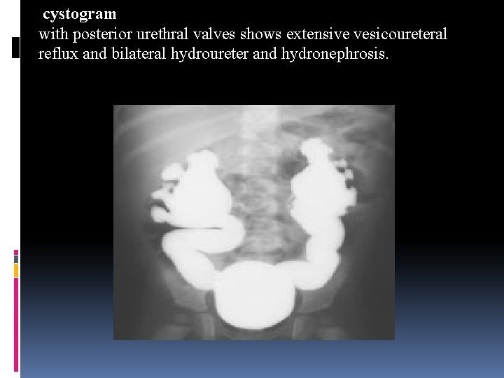  cystogram with posterior urethral valves shows extensive vesicoureteral reflux and bilateral hydroureter and