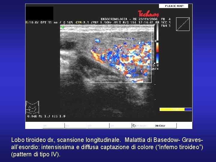 Lobo tiroideo dx, scansione longitudinale. Malattia di Basedow- Gravesall’esordio: intensissima e diffusa captazione di