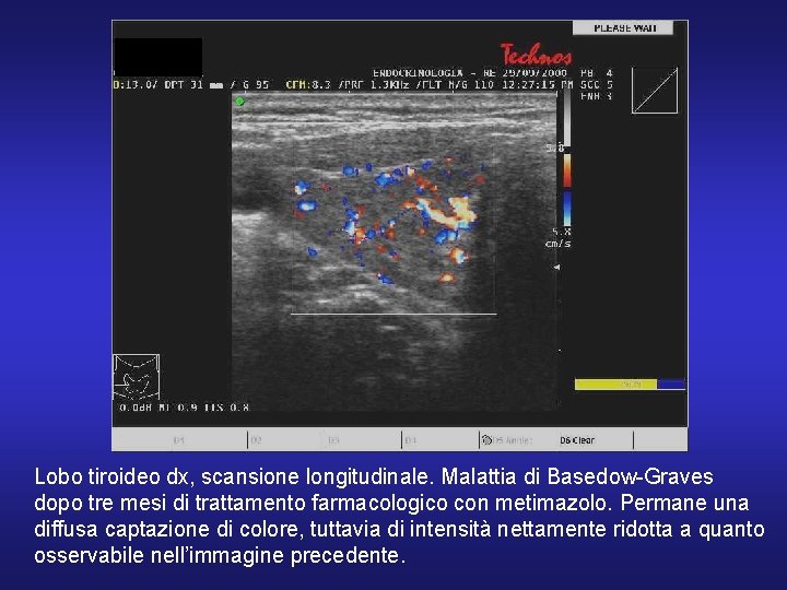 Lobo tiroideo dx, scansione longitudinale. Malattia di Basedow-Graves dopo tre mesi di trattamento farmacologico