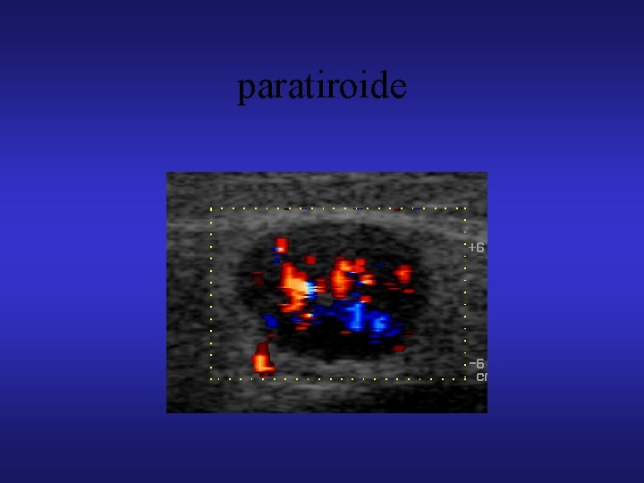 paratiroide 