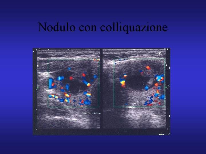 Nodulo con colliquazione 