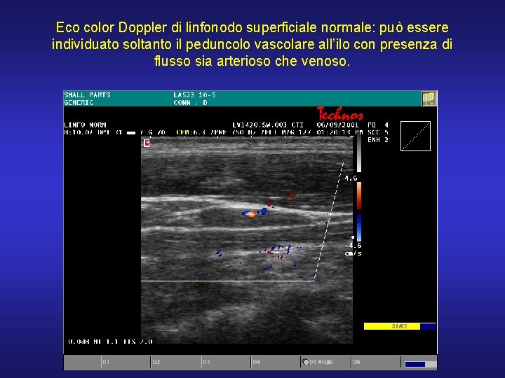 Eco color Doppler di linfonodo superficiale normale: può essere individuato soltanto il peduncolo vascolare