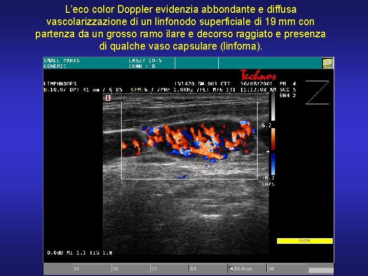 L’eco color Doppler evidenzia abbondante e diffusa vascolarizzazione di un linfonodo superficiale di 19