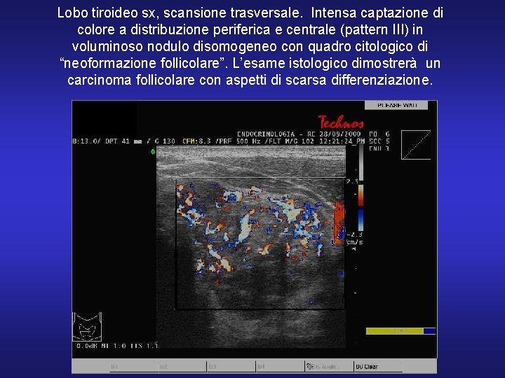 Lobo tiroideo sx, scansione trasversale. Intensa captazione di colore a distribuzione periferica e centrale