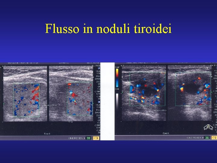 Flusso in noduli tiroidei 