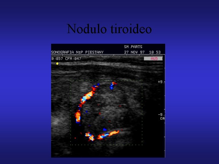 Nodulo tiroideo 