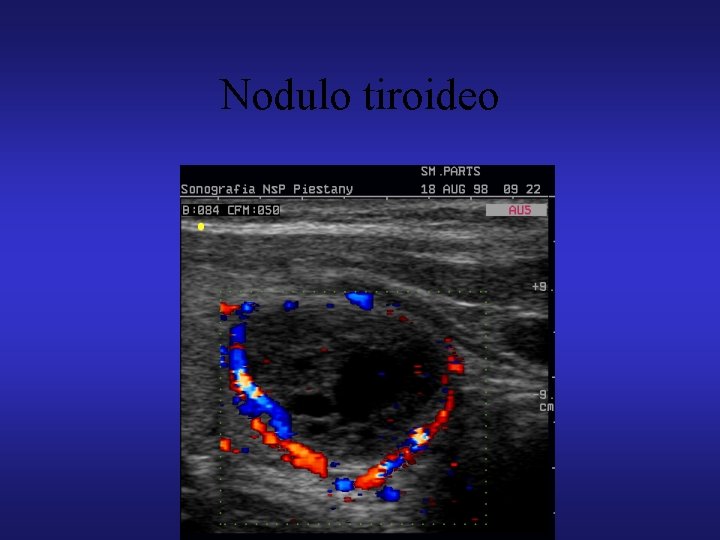 Nodulo tiroideo 