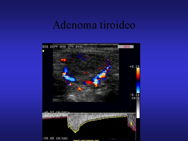 Adenoma tiroideo 
