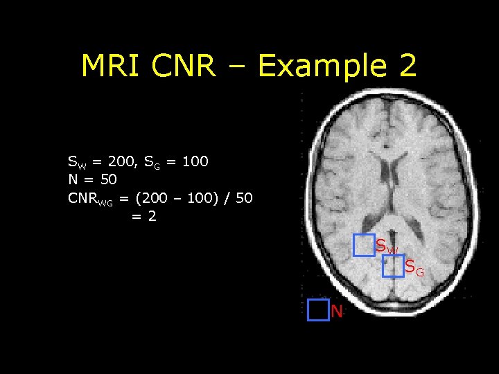 MRI CNR – Example 2 SW = 200, SG = 100 N = 50