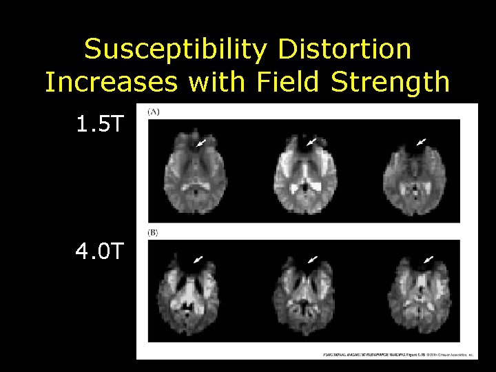 Susceptibility Distortion Increases with Field Strength 1. 5 T 4. 0 T 