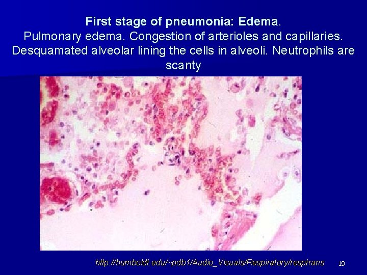 First stage of pneumonia: Edema. Pulmonary edema. Congestion of arterioles and capillaries. Desquamated alveolar