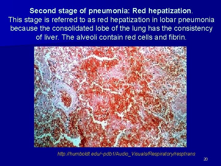 Second stage of pneumonia: Red hepatization. This stage is referred to as red hepatization