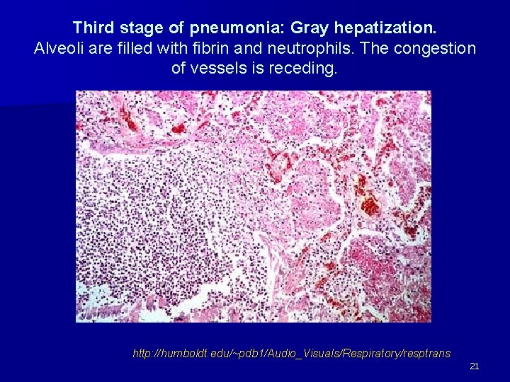 Third stage of pneumonia: Gray hepatization. Alveoli are filled with fibrin and neutrophils. The