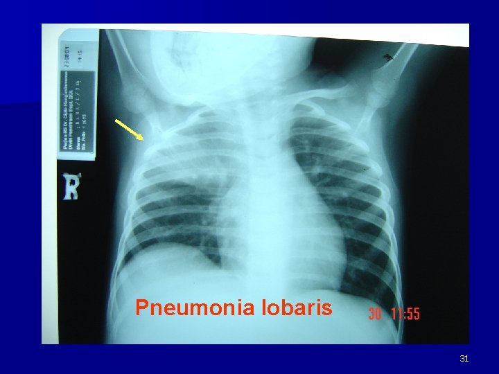 Pneumonia lobaris 31 