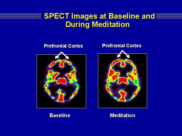 SPECT Images at Baseline and During Meditation Prefrontal Cortex Baseline Prefrontal Cortex Meditation SPECT Images at Baseline and During Meditation Prefrontal Cortex Baseline Prefrontal Cortex Meditation