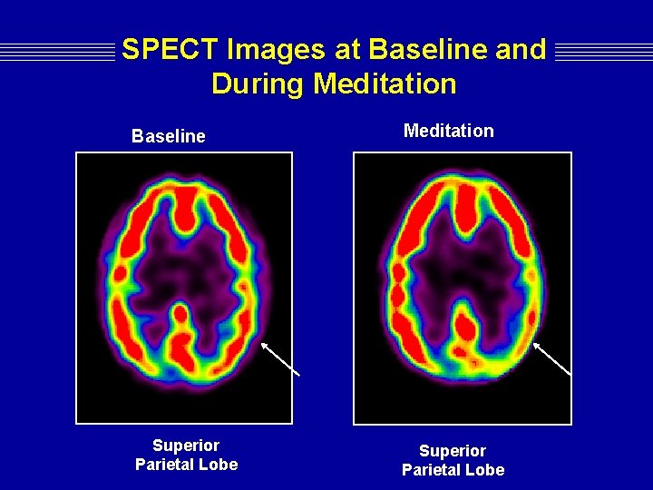 SPECT Images at Baseline and During Meditation Baseline Meditation Superior Parietal Lobe SPECT Images at Baseline and During Meditation Baseline Meditation Superior Parietal Lobe