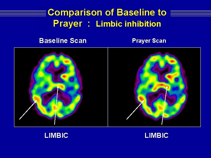 Comparison of Baseline to Prayer : Limbic inhibition Baseline Scan LIMBIC Prayer Scan LIMBIC Comparison of Baseline to Prayer : Limbic inhibition Baseline Scan LIMBIC Prayer Scan LIMBIC