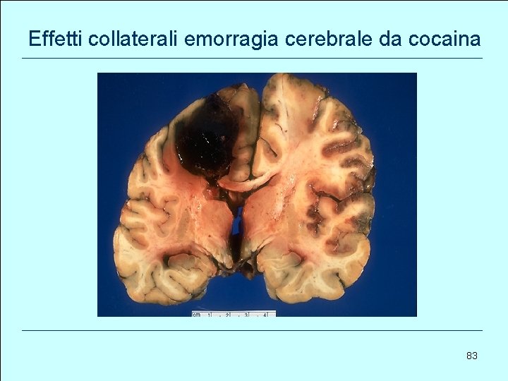 Effetti collaterali emorragia cerebrale da cocaina 83 