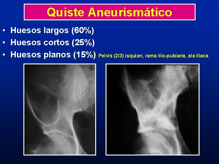 Quiste Aneurismático • Huesos largos (60%) • Huesos cortos (25%) • Huesos planos (15%) Quiste Aneurismático • Huesos largos (60%) • Huesos cortos (25%) • Huesos planos (15%)
