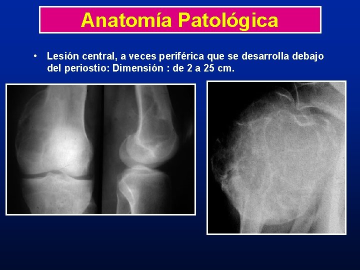 Anatomía Patológica • Lesión central, a veces periférica que se desarrolla debajo del periostio: Anatomía Patológica • Lesión central, a veces periférica que se desarrolla debajo del periostio: