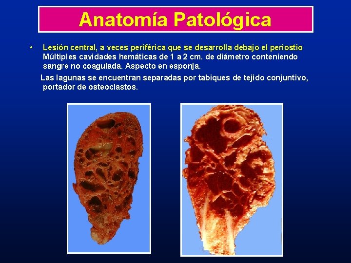 Anatomía Patológica • Lesión central, a veces periférica que se desarrolla debajo el periostio