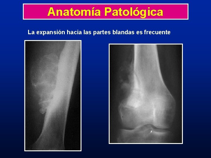 Anatomía Patológica La expansión hacia las partes blandas es frecuente 