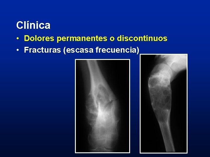 Clínica • Dolores permanentes o discontínuos • Fracturas (escasa frecuencia) 