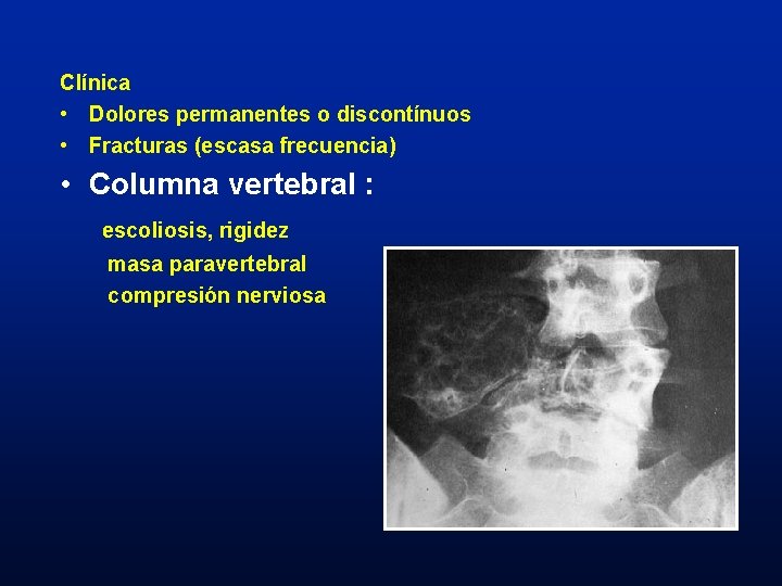 Clínica • Dolores permanentes o discontínuos • Fracturas (escasa frecuencia) • Columna vertebral :