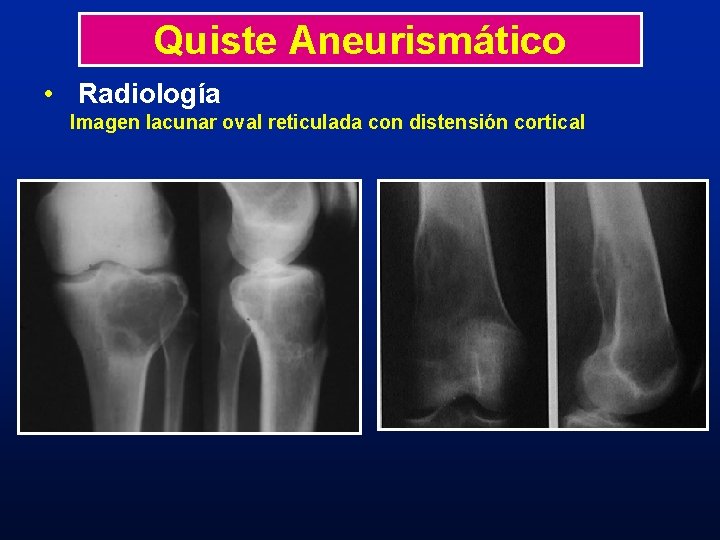 Quiste Aneurismático • Radiología Imagen lacunar oval reticulada con distensión cortical Quiste Aneurismático • Radiología Imagen lacunar oval reticulada con distensión cortical