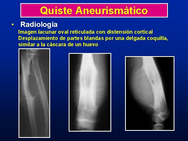 Quiste Aneurismático • Radiología Imagen lacunar oval reticulada con distensión cortical Desplazamiento de partes