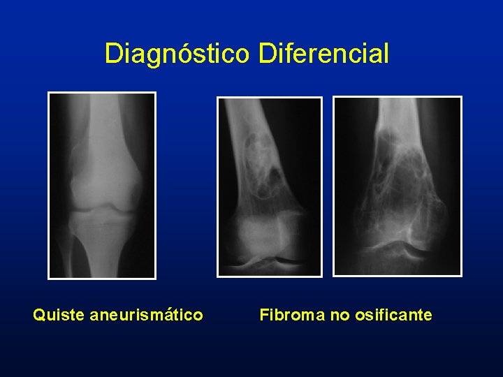 Diagnóstico Diferencial Quiste aneurismático Fibroma no osificante 