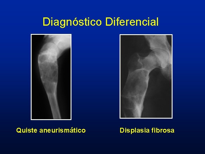 Diagnóstico Diferencial Quiste aneurismático Displasia fibrosa 