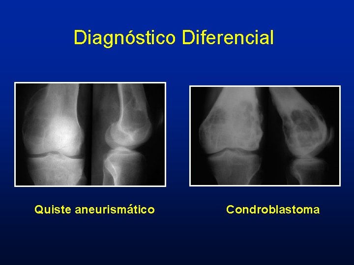 Diagnóstico Diferencial Quiste aneurismático Condroblastoma Diagnóstico Diferencial Quiste aneurismático Condroblastoma