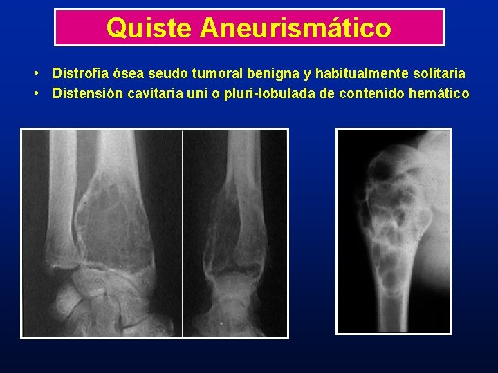 Quiste Aneurismático • Distrofia ósea seudo tumoral benigna y habitualmente solitaria • Distensión cavitaria Quiste Aneurismático • Distrofia ósea seudo tumoral benigna y habitualmente solitaria • Distensión cavitaria
