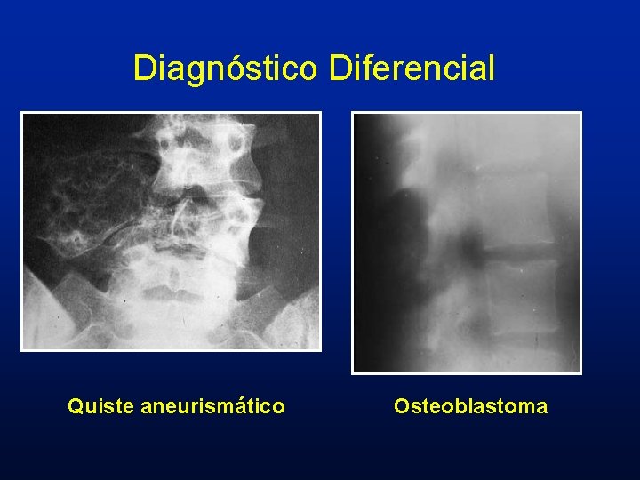 Diagnóstico Diferencial Quiste aneurismático Osteoblastoma 